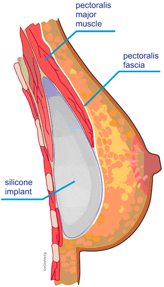 Breast Augmentation Implant Position image