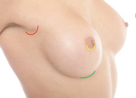 Breast Augmentation - Customer results