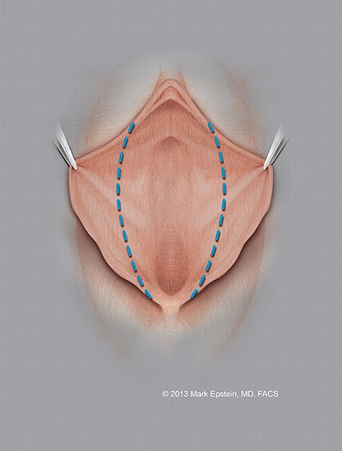 Labiaplasty Edge Trim Image